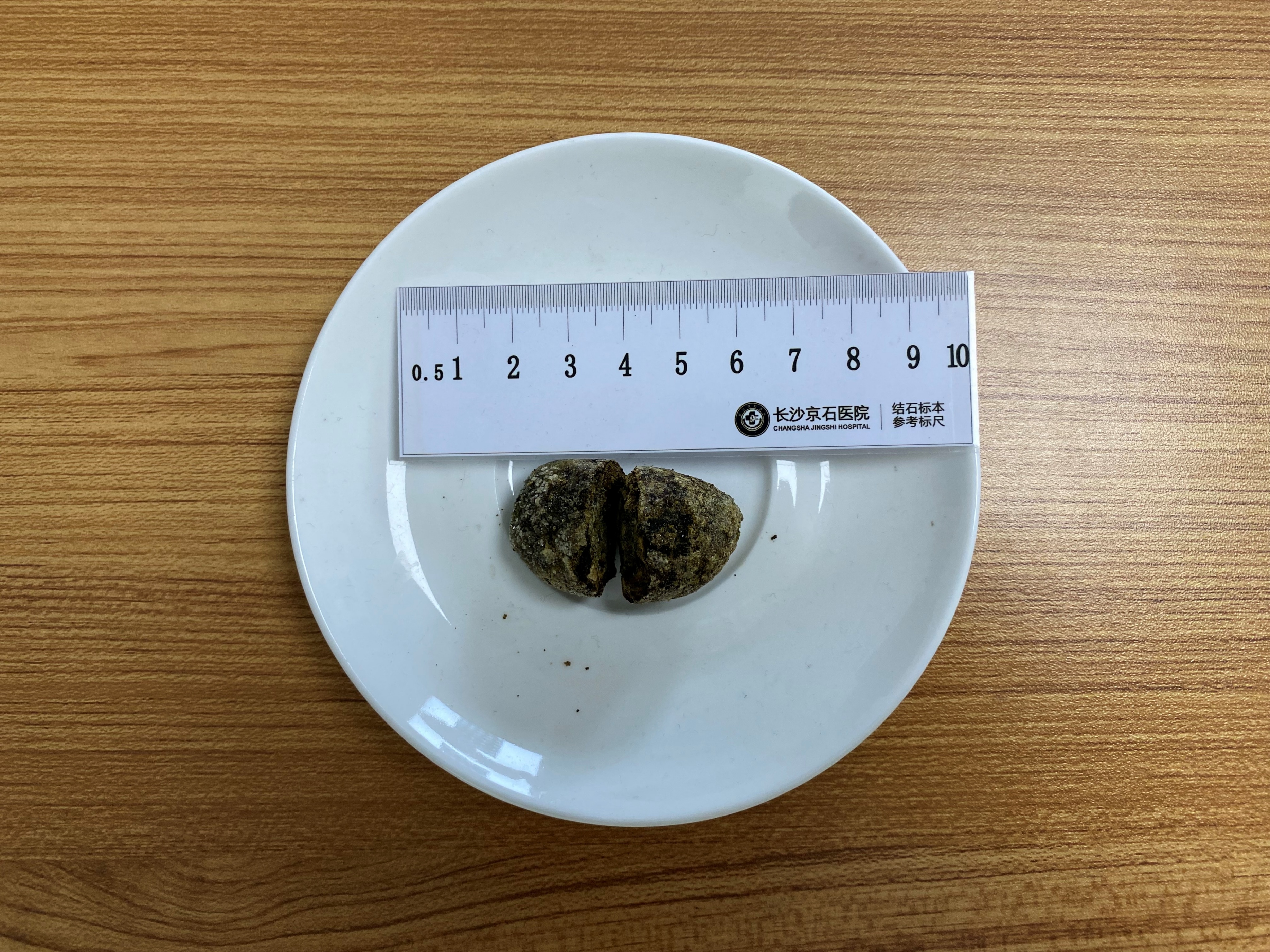 女子常年熬夜晚睡不吃早餐,女子长期不吃早饭得200多颗结石