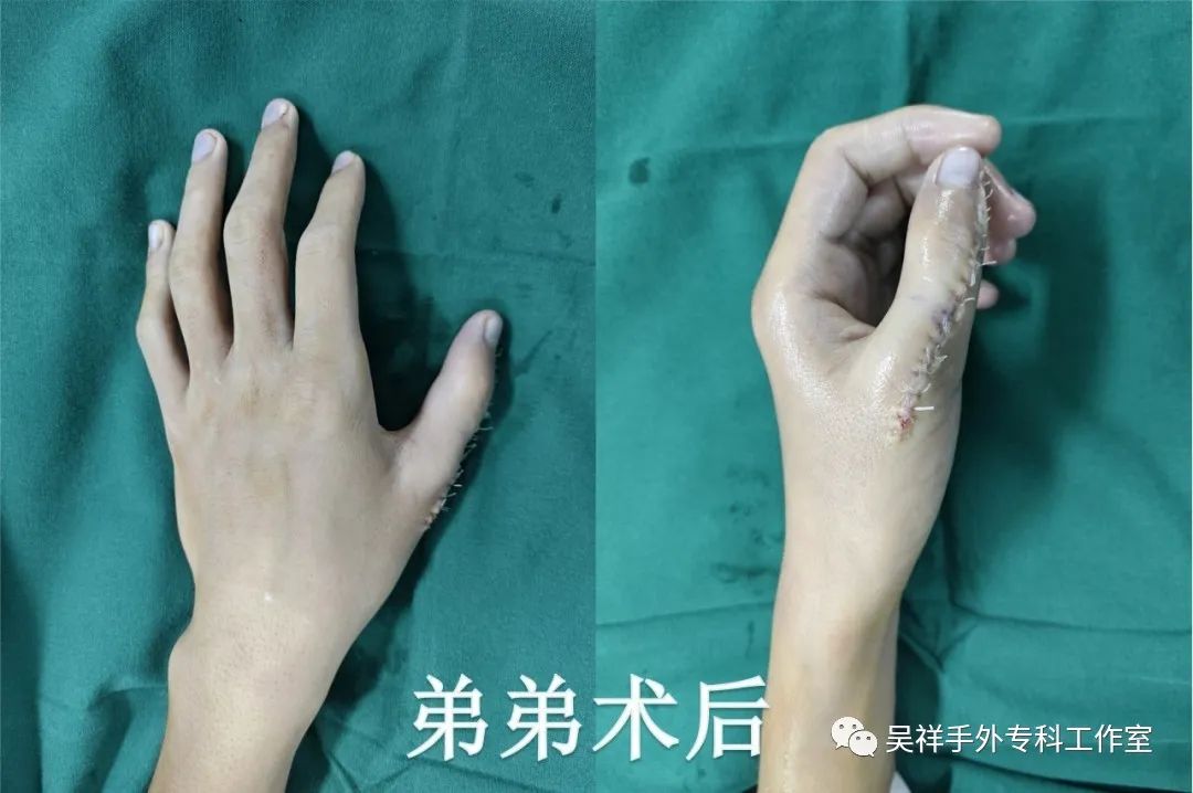 罕见同卵不同性别的双胞胎,罕见四胞胎长得一模一样