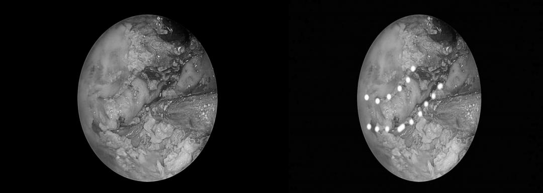 南昌二附院耳鼻喉科手术,南昌大学第二附属医院耳鼻咽喉科