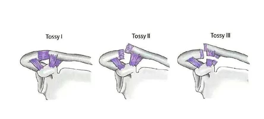 肩锁关节脱位手术多久能干体力活,左肩锁关节脱位拆钢板后多久恢复