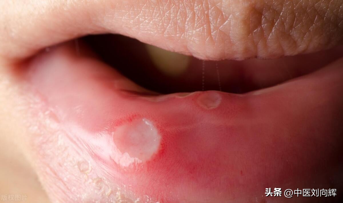 溃疡一直不好怎么办,溃疡久治不好有什么妙招