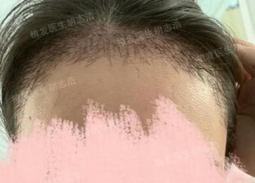 植发后后枕部的头发多久能恢复,植发手术后3个月恢复过程