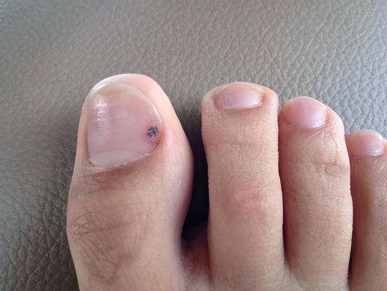 黑痣发生这些变化时要警惕,医生长在摩擦部位的黑痣要当心