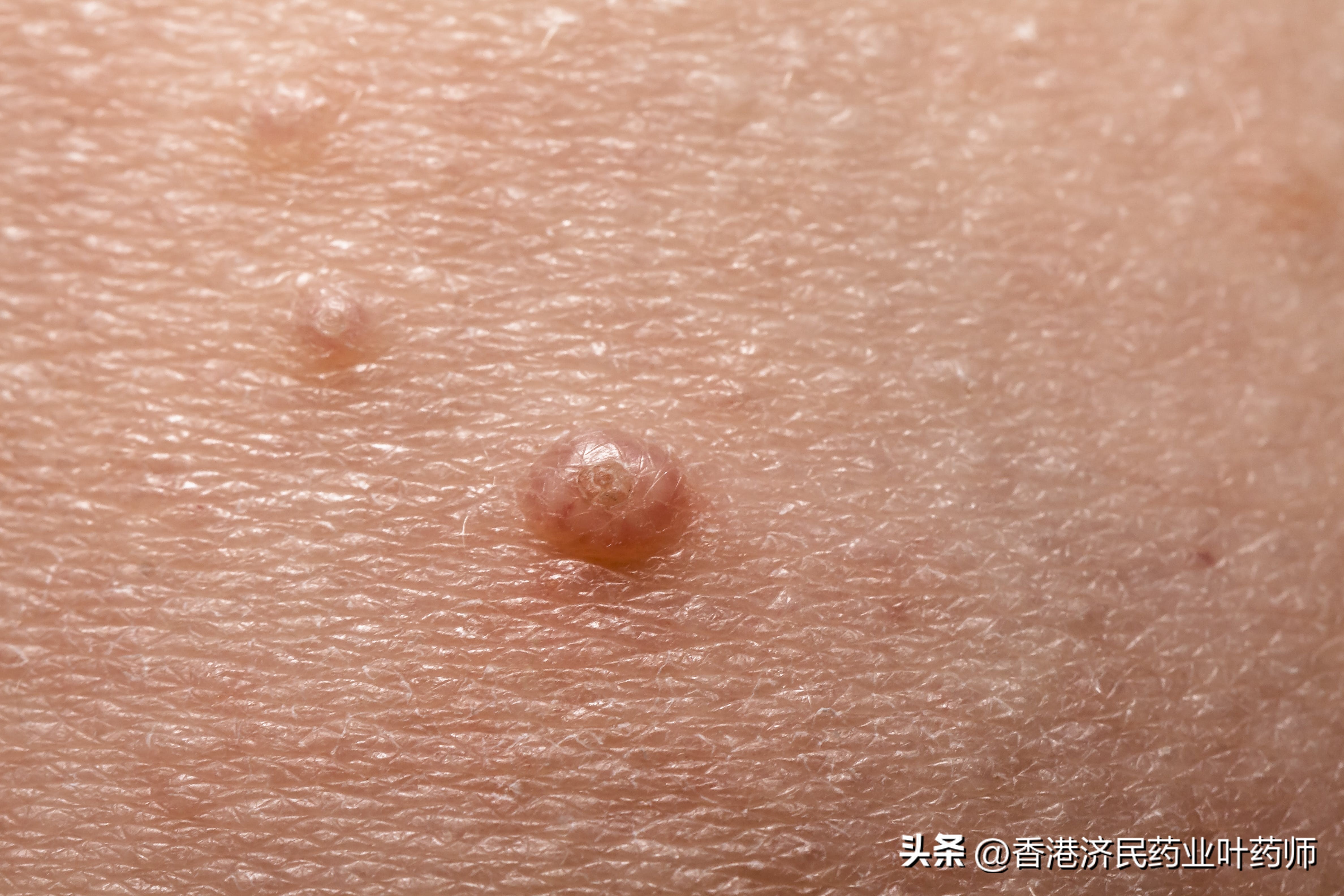 斑蝥素软膏治疗软疣,斑蝥素除传染性软疣的过程