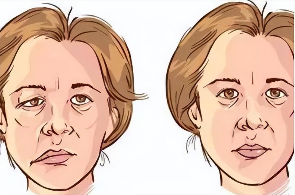 面瘫口眼歪斜怎么治疗最好,中风面瘫口眼歪斜怎么治