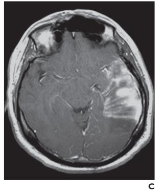 脑水肿的影像,脑水肿形成机制生理学