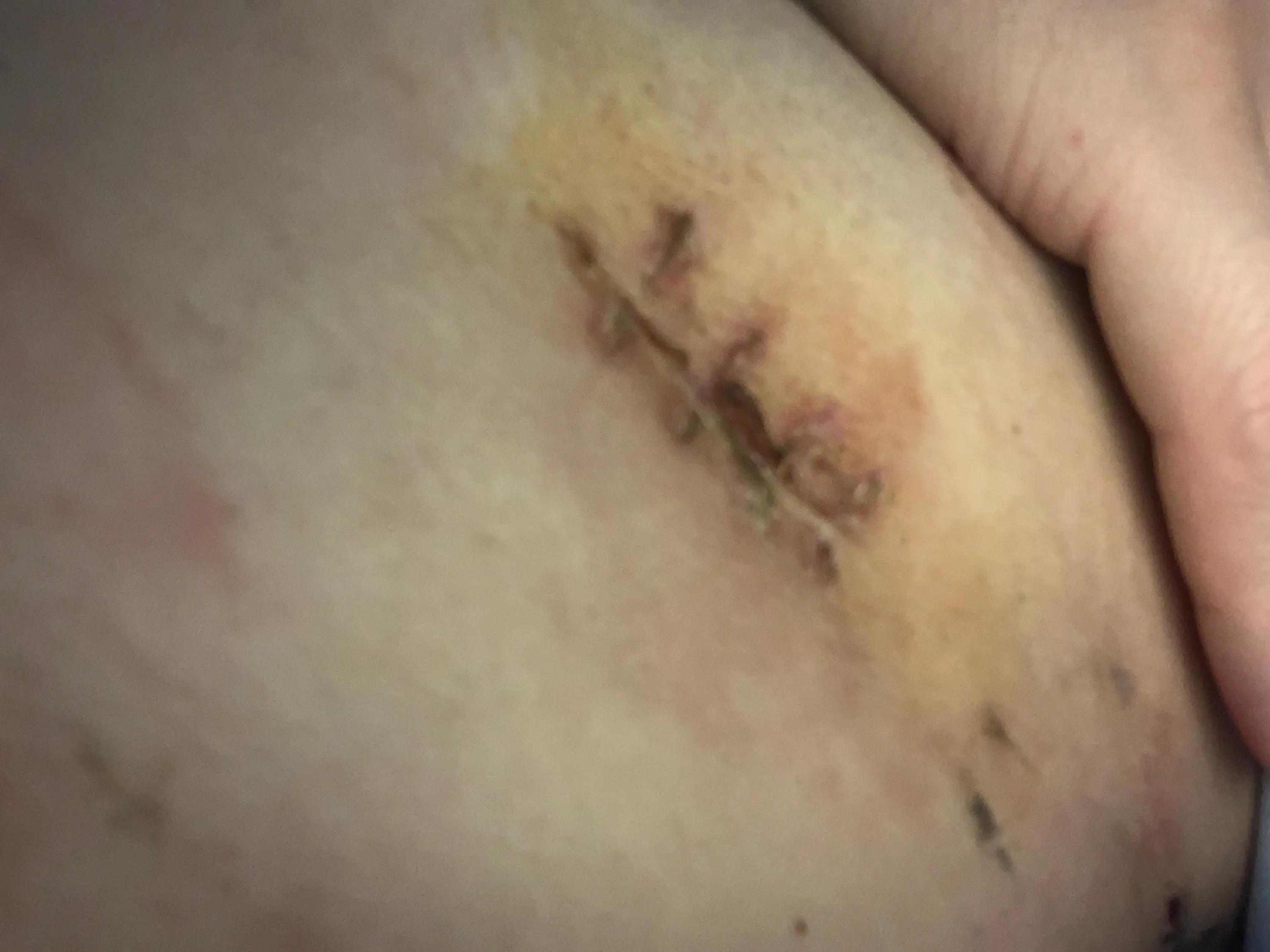 磨玻璃结节是怎么样做手术的,磨玻璃结节手术属于几级手术