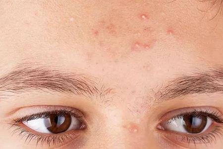 长痘痘应该如何正确处理,长痘痘的好处与坏处