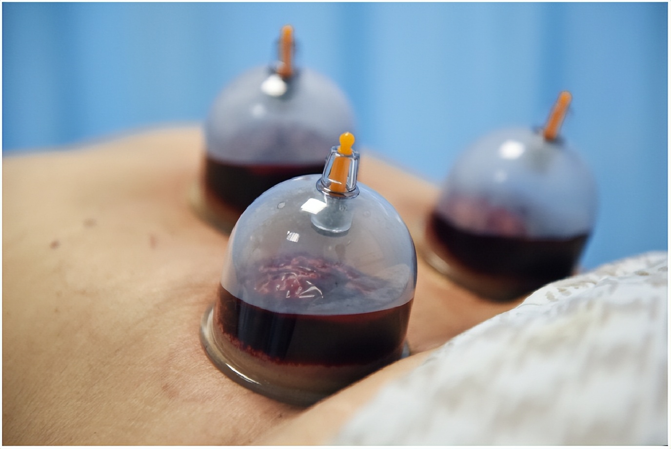 刺络拔罐治什么病,刺络拔罐全过程