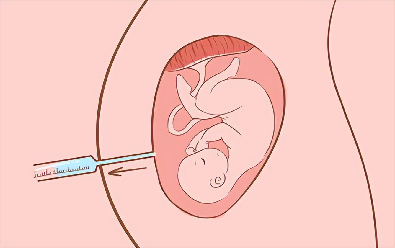 妊娠糖尿病孕晚期怎么做,孕妇妊娠糖尿病嘴好馋