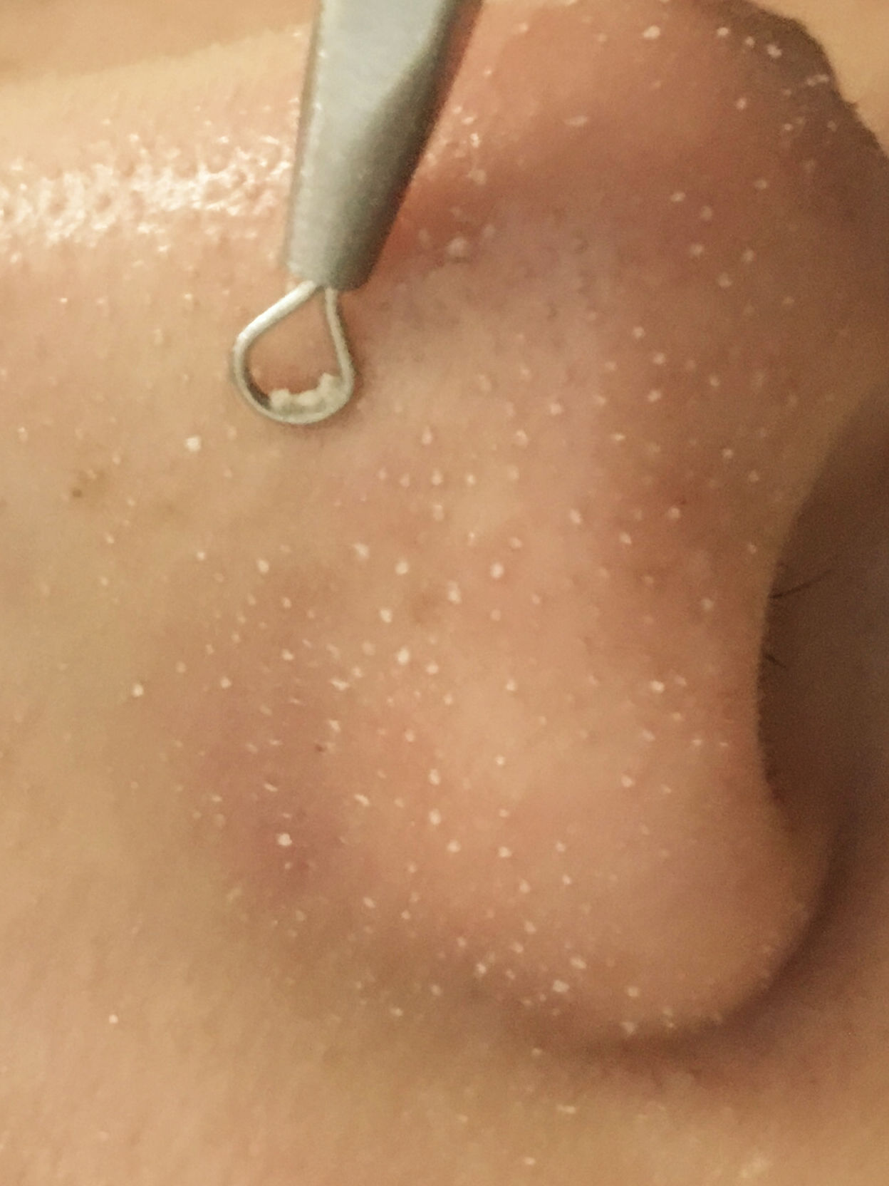 鼻子毛孔堵塞凸起有油脂粒,鼻子毛孔粗大有油脂粒怎么办