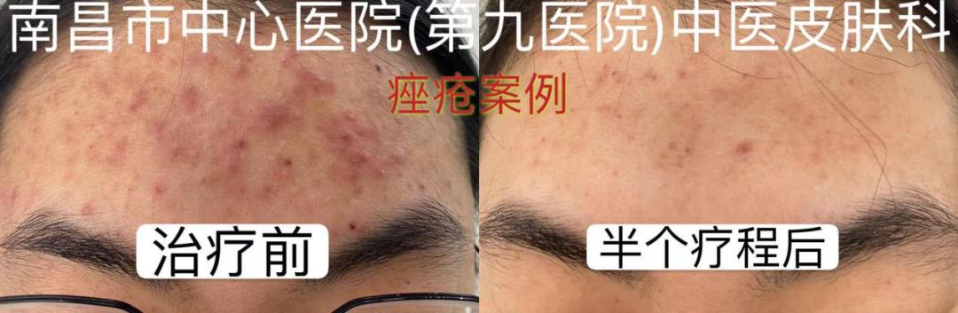 想拥有光滑无痘的脸，别再做这个动作了