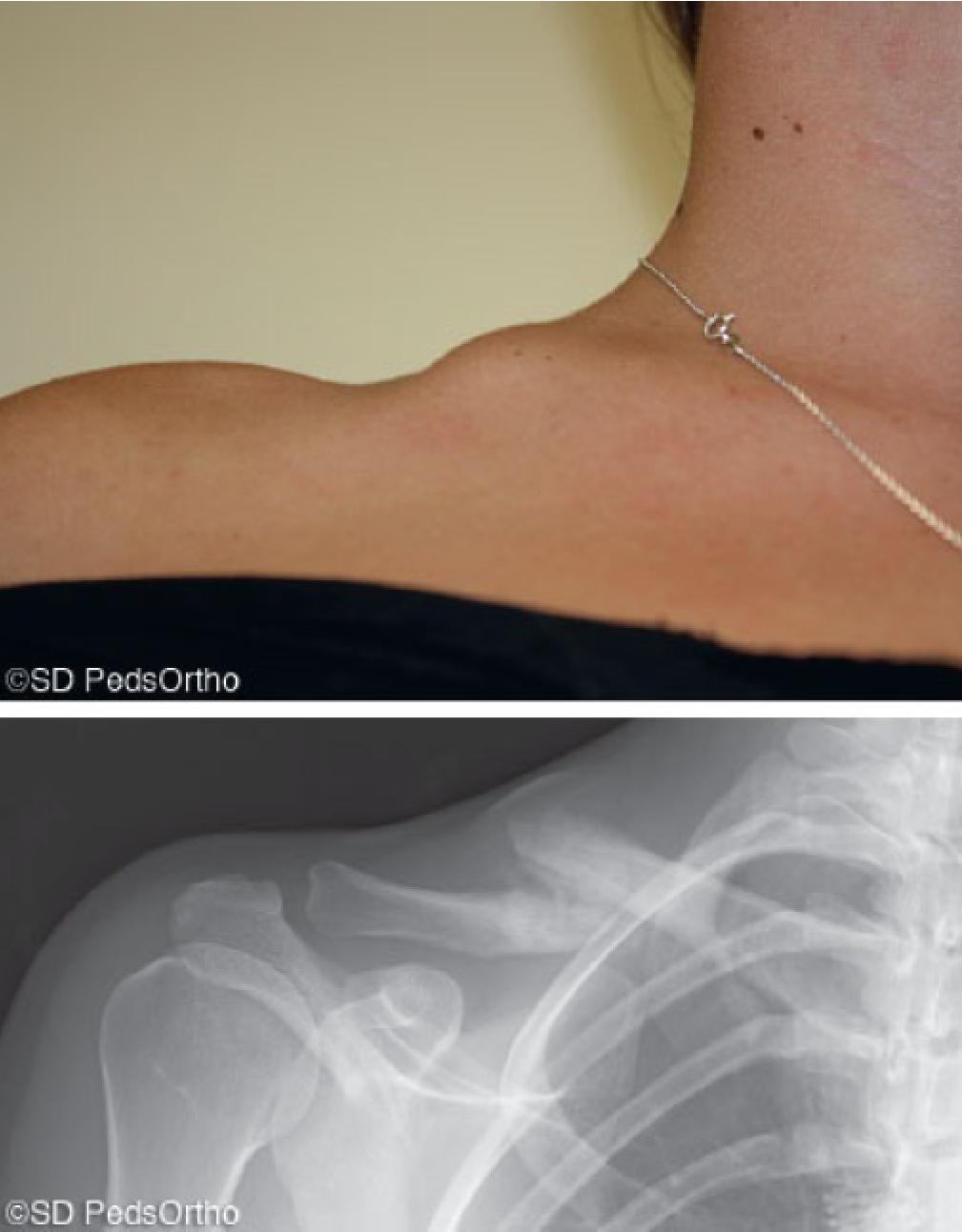 锁骨骨折吃什么食物最好,锁骨骨折怎么绑绷带视频