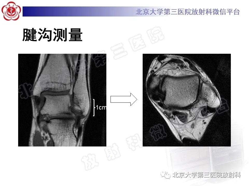 好文分享续集,腓骨肌腱脱位手术价格