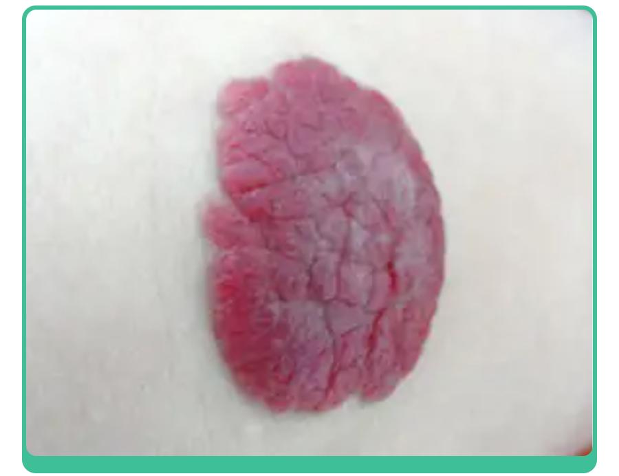 宝宝手上长胎记，一查竟是血管瘤！医生：这5种胎记要早处理