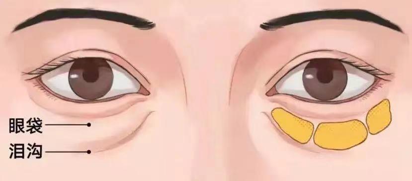 有效去黑眼圈和泪沟方法,黑眼圈泪沟抗衰老