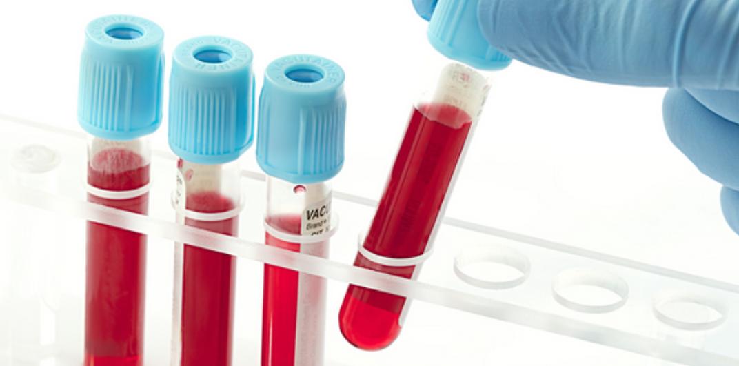 血管堵不堵劝你及时做好4件事,血管不好血难抽如何改善血管