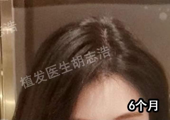 植发手术后恢复全过程,植发手术全过程详解