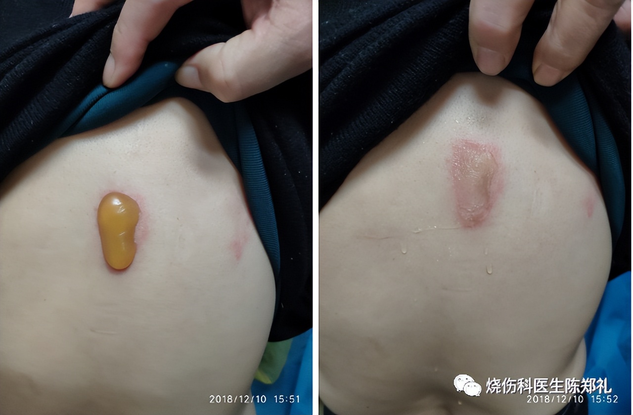 小孩不听话进厨房被烫伤,小朋友被油锅烫伤怎么办