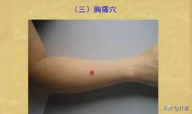 一招治愈心绞痛,一针救心脏病