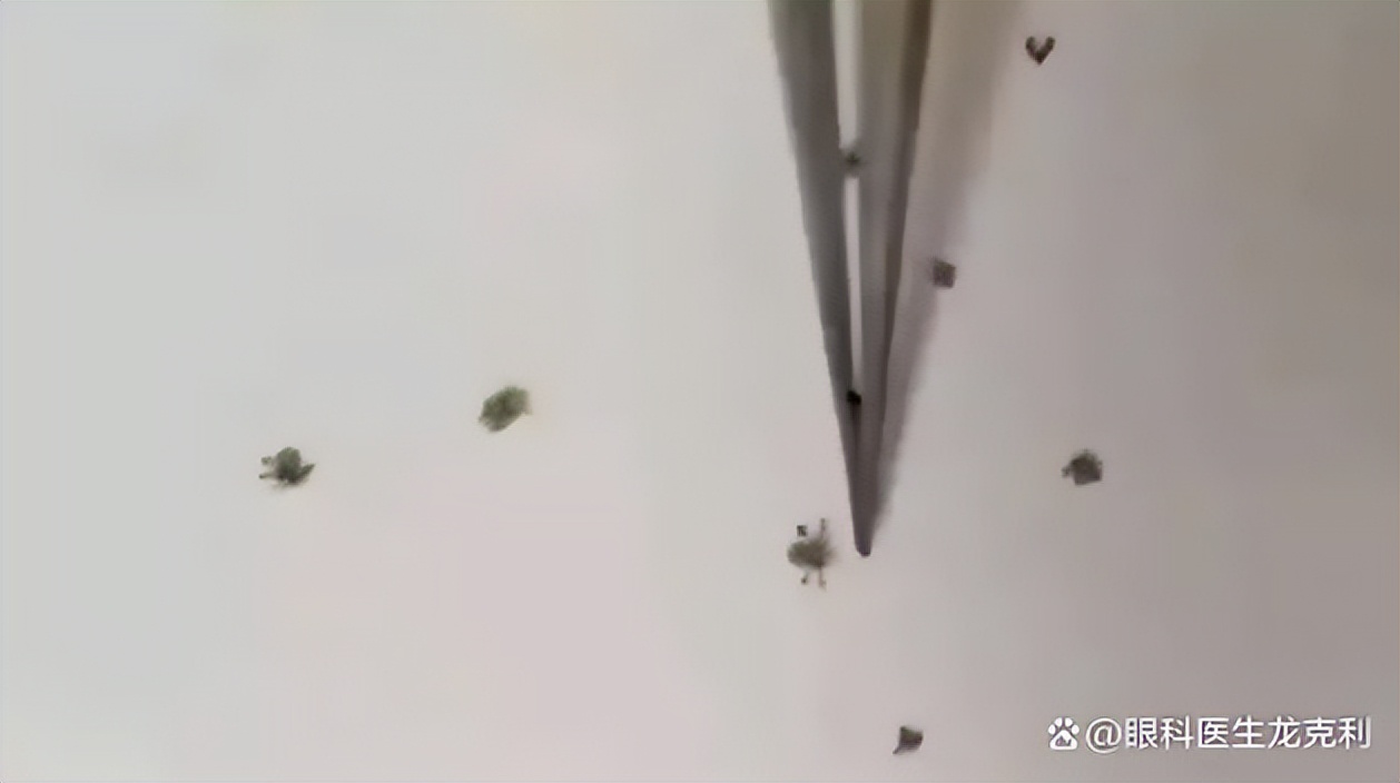 眼睛会看到虫子是什么原因,眼睛里面有虫子的特征