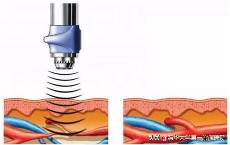 它来了！缓解腱鞘炎、网球肘、筋膜炎的“神器”