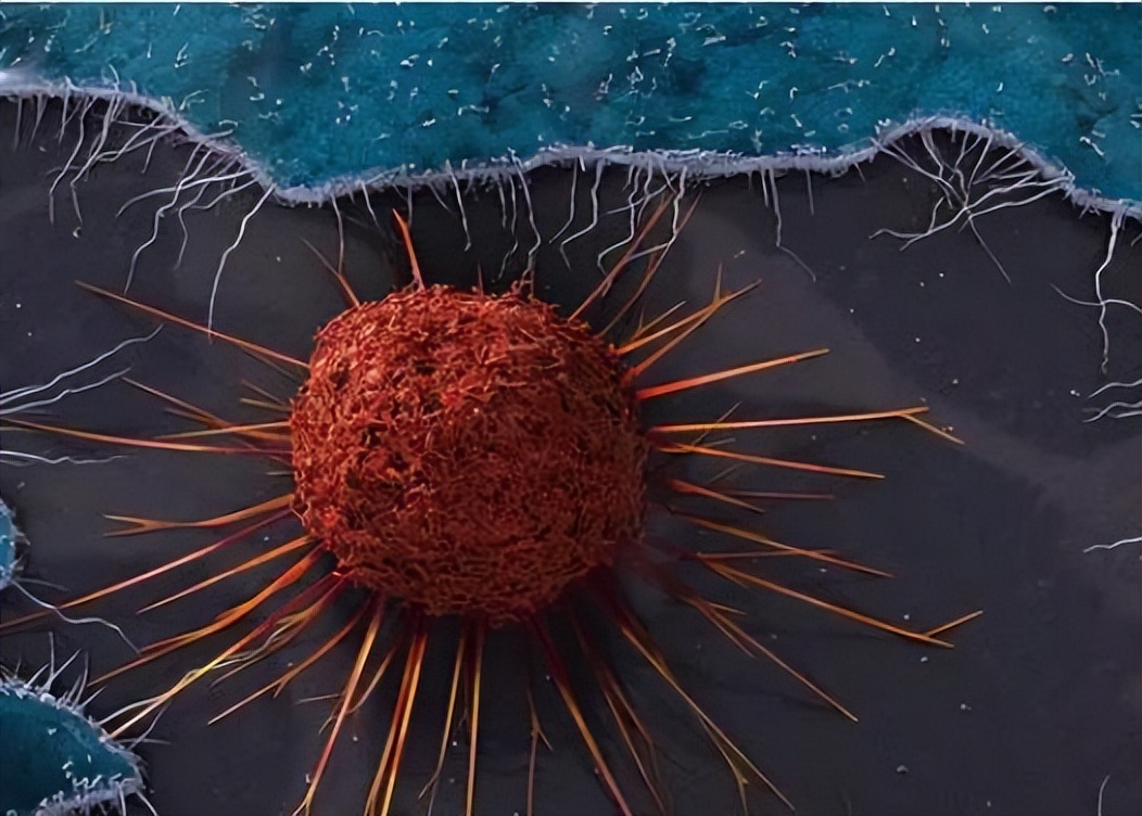 宫颈癌做了子宫全切术复发的症状,宫颈癌子宫肥大症状