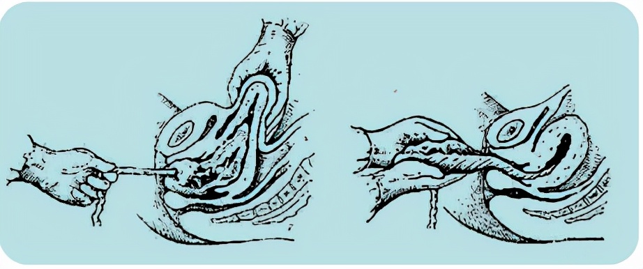 孕妈妈怎么判断胎位是正的,胎儿屁股在右侧是什么胎位