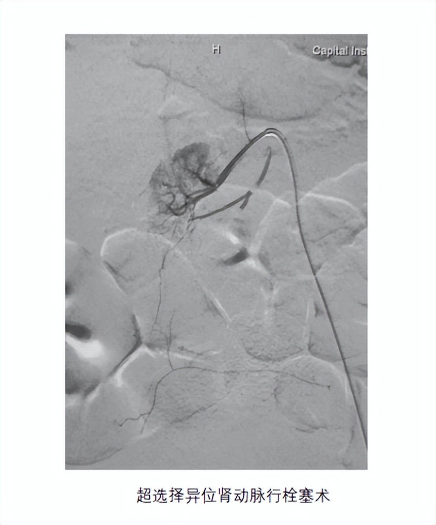 异位肾最佳治疗方法,异位肾要做手术吗