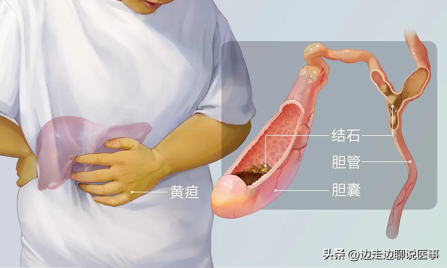 胆结石频繁发作疼得要死怎么办,胆结石发作如何减少疼痛