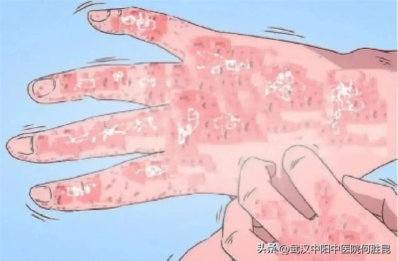 胳膊窝有疹子痒的厉害怎么办,手肘痒起疙瘩越抓越痒还脱皮