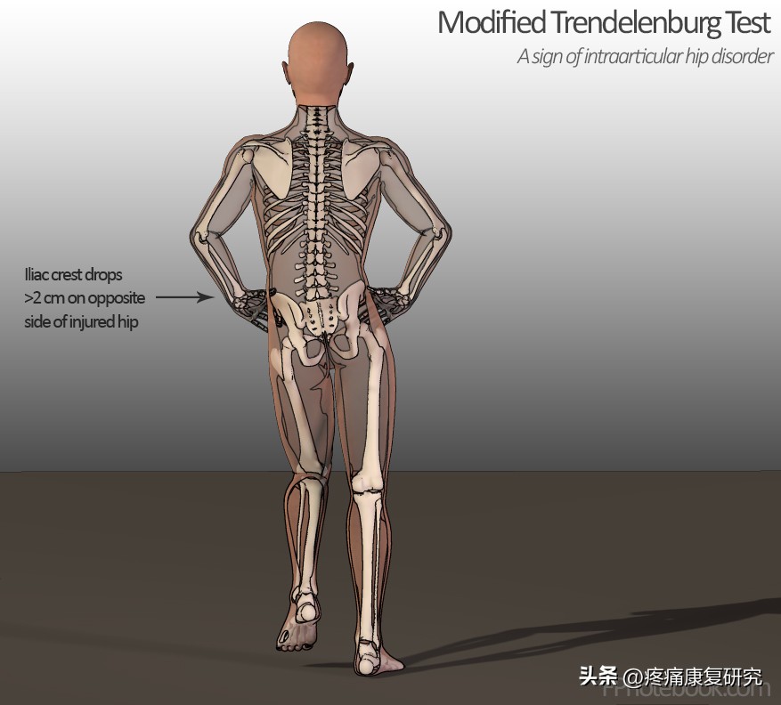 髋部无力,膝关节疼痛与髋部疾病有何关联