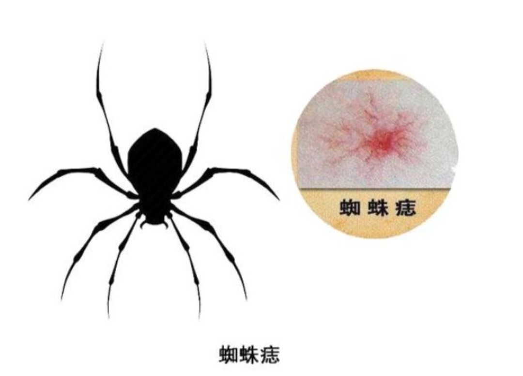 身上出现小红点是怎么回事没感觉,身上出现大面积小红点不痛不痒的