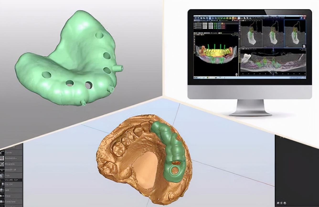 数字化导板微创种植牙,数字化3d导航种植牙