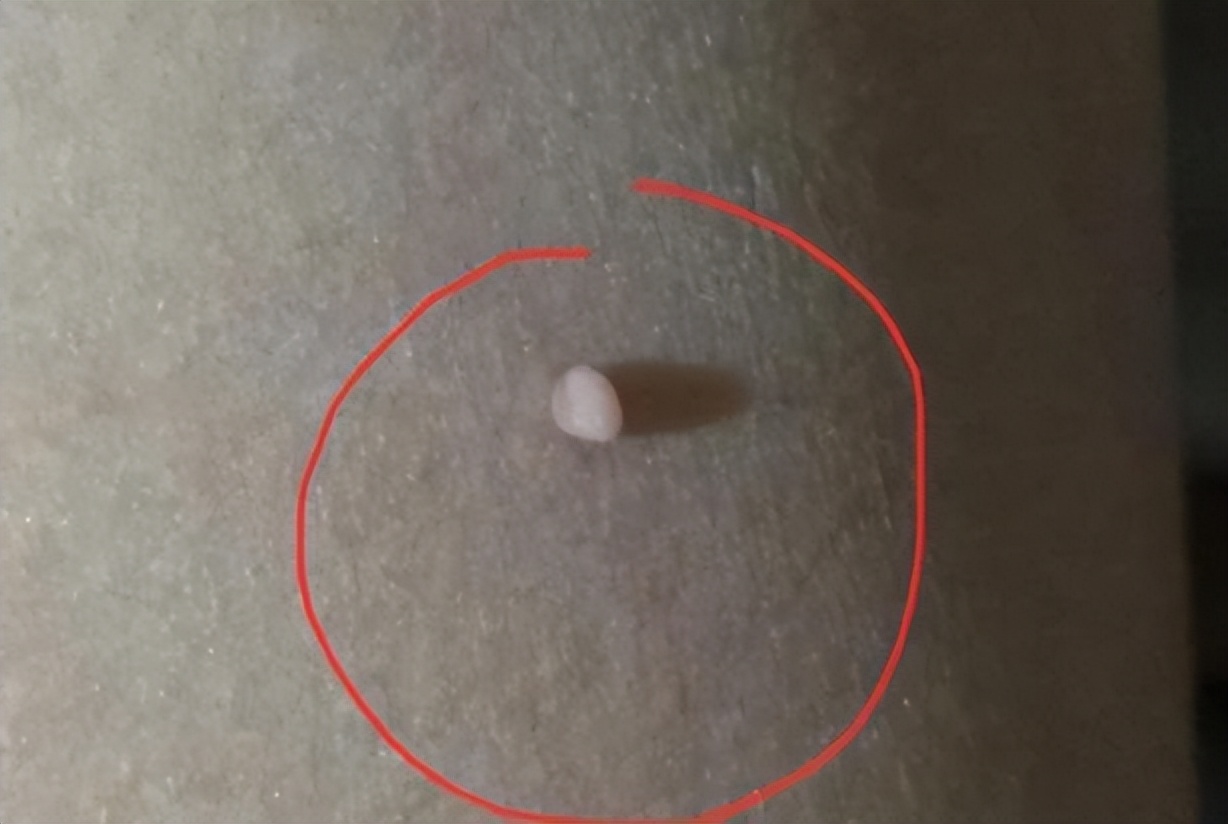 脖子和腋下有小肉揪是什么,脖子和腋下的小肉粒