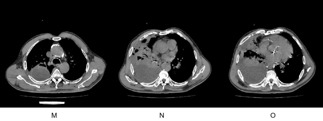 mrsa用什么药,mrsa对哪些药物敏感