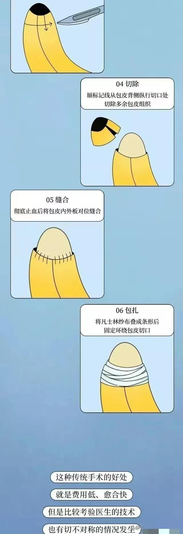 割完包皮的男人,男性割完包皮