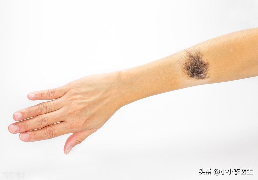 激光祛痣笔真的有用吗,冷冻祛痣好还是激光好