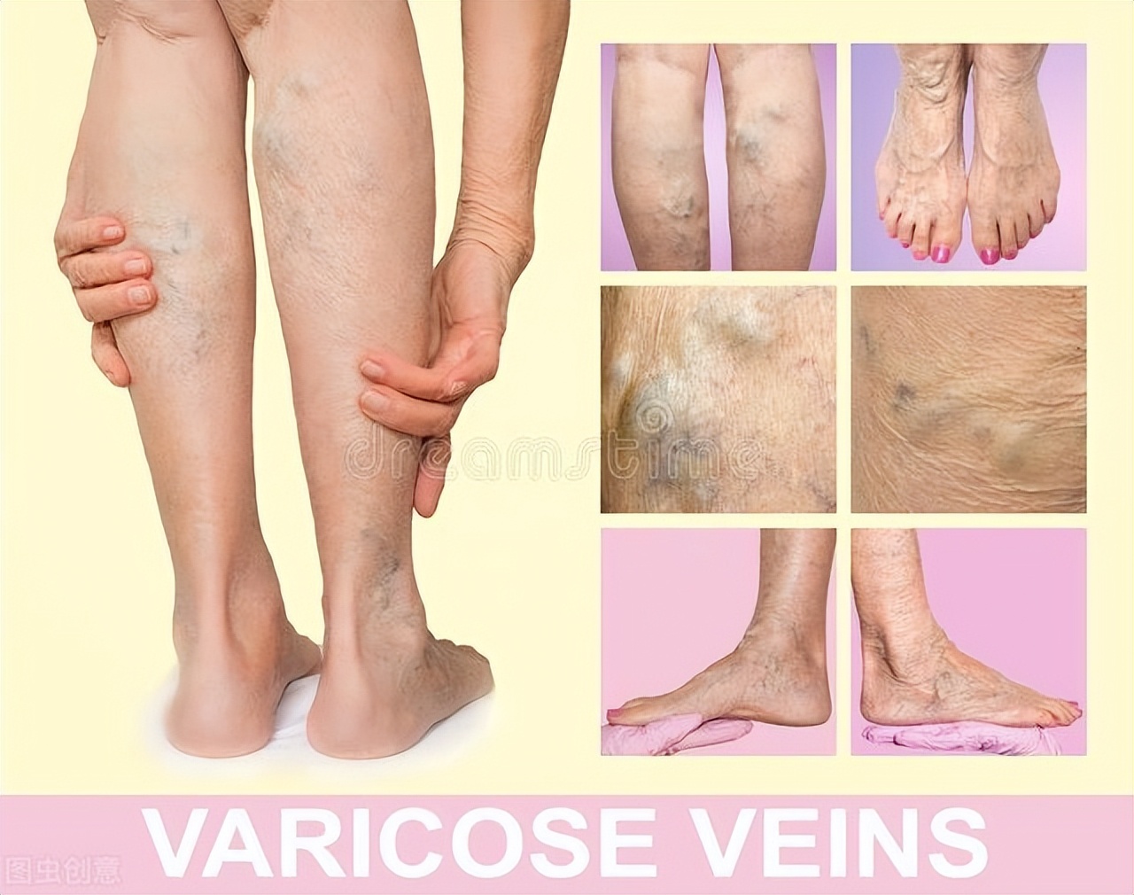 孕期静脉曲张治疗最好方法,怀孕期间静脉曲张的最快消除方法