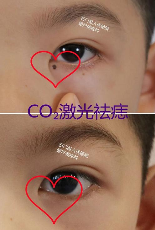 美丽无需“痣”疑！有痣别乱点，这些方法最靠谱