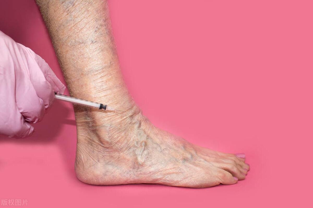 活血化瘀偏方能治疗静脉曲张吗,农村偏方治静脉曲张最有效的方法