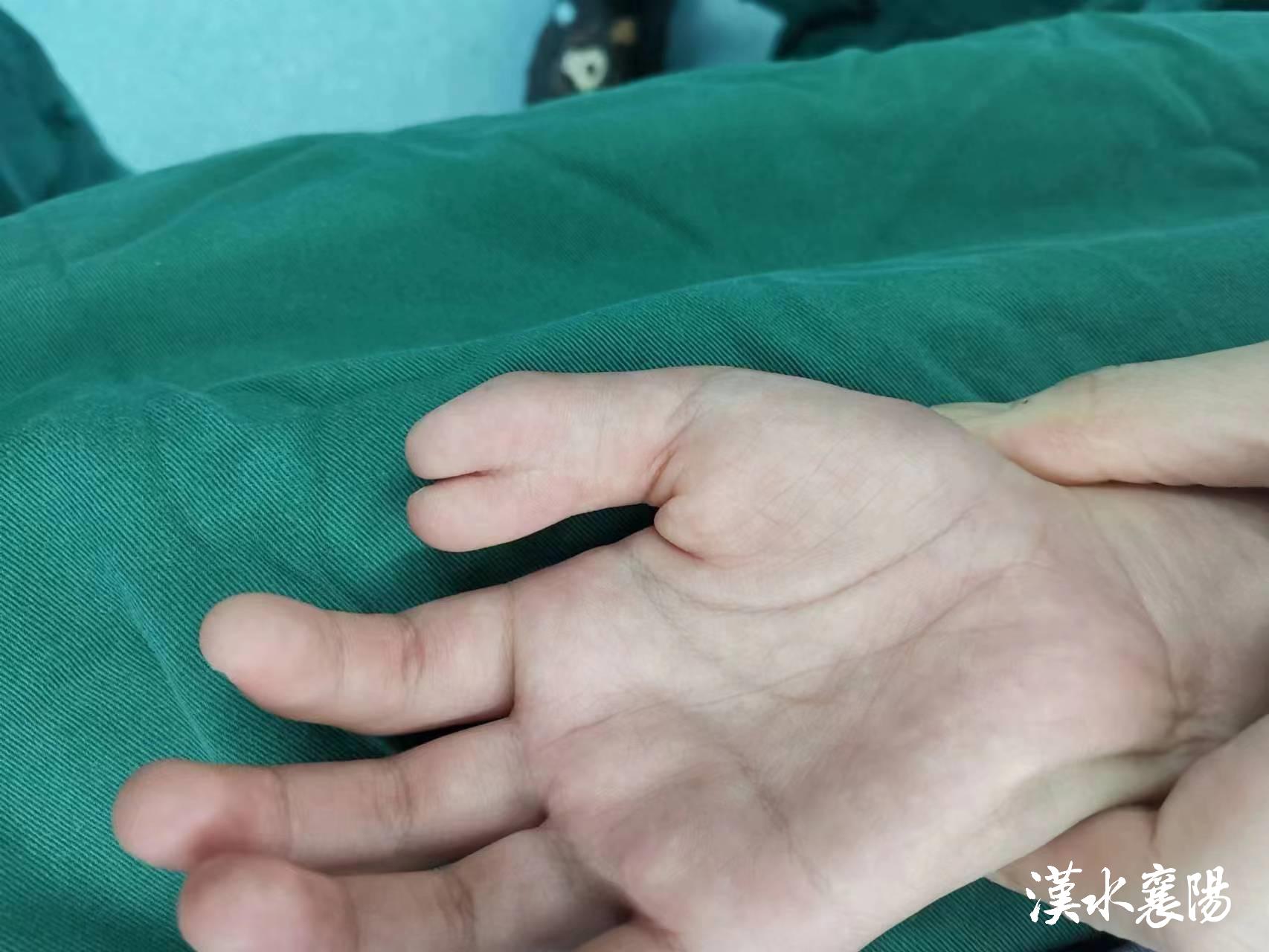 手指弯曲畸形治疗22岁女,蟹形手指畸形怎么手术