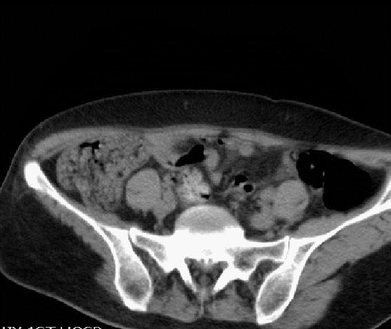 脊索瘤造成骨质破坏严重吗,多发椎体骨质破坏考虑转移瘤