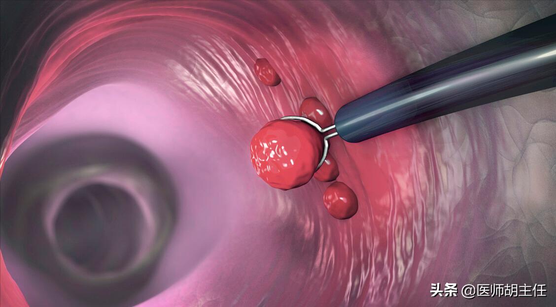 如果肠道长息肉身体会有哪些反应,肠道长息肉会有什么症状