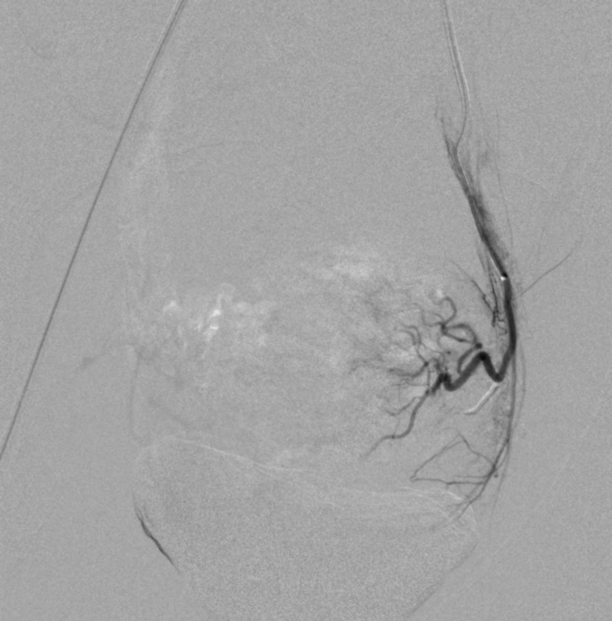 14岁女孩PROS综合症伴月经出血不止介入治疗病例