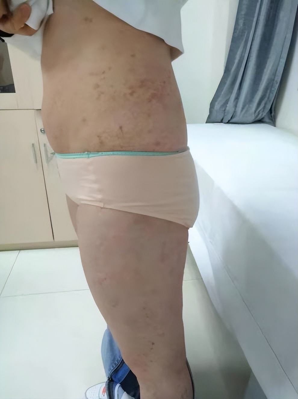 银屑病：皮肤上的“牛皮癣”！反反复复难痊愈，治疗应该怎么办？