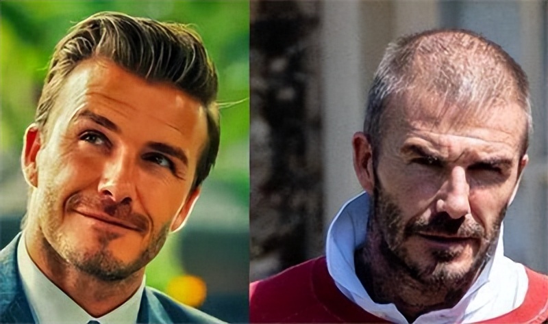 雄秃是哪里出了问题,雄秃真的无解吗