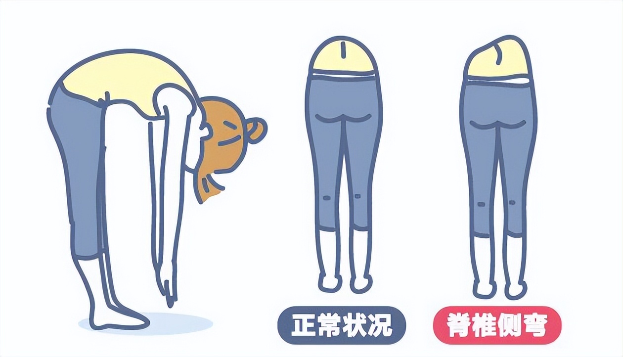 成人脊椎侧弯了还能矫正吗？脊椎侧弯要怎么自愈？