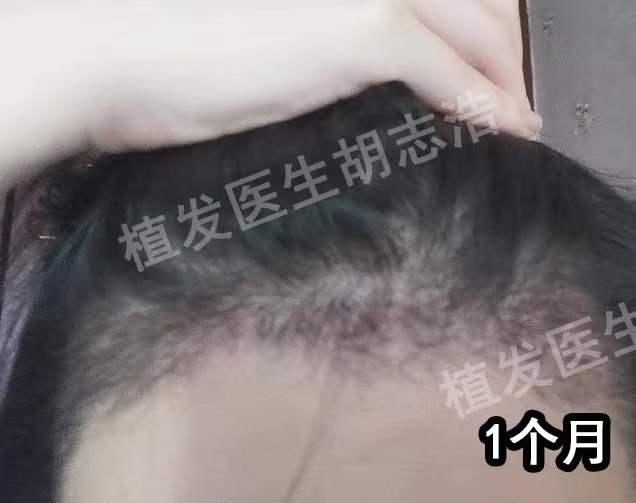 植发手术后恢复全过程,植发手术全过程详解