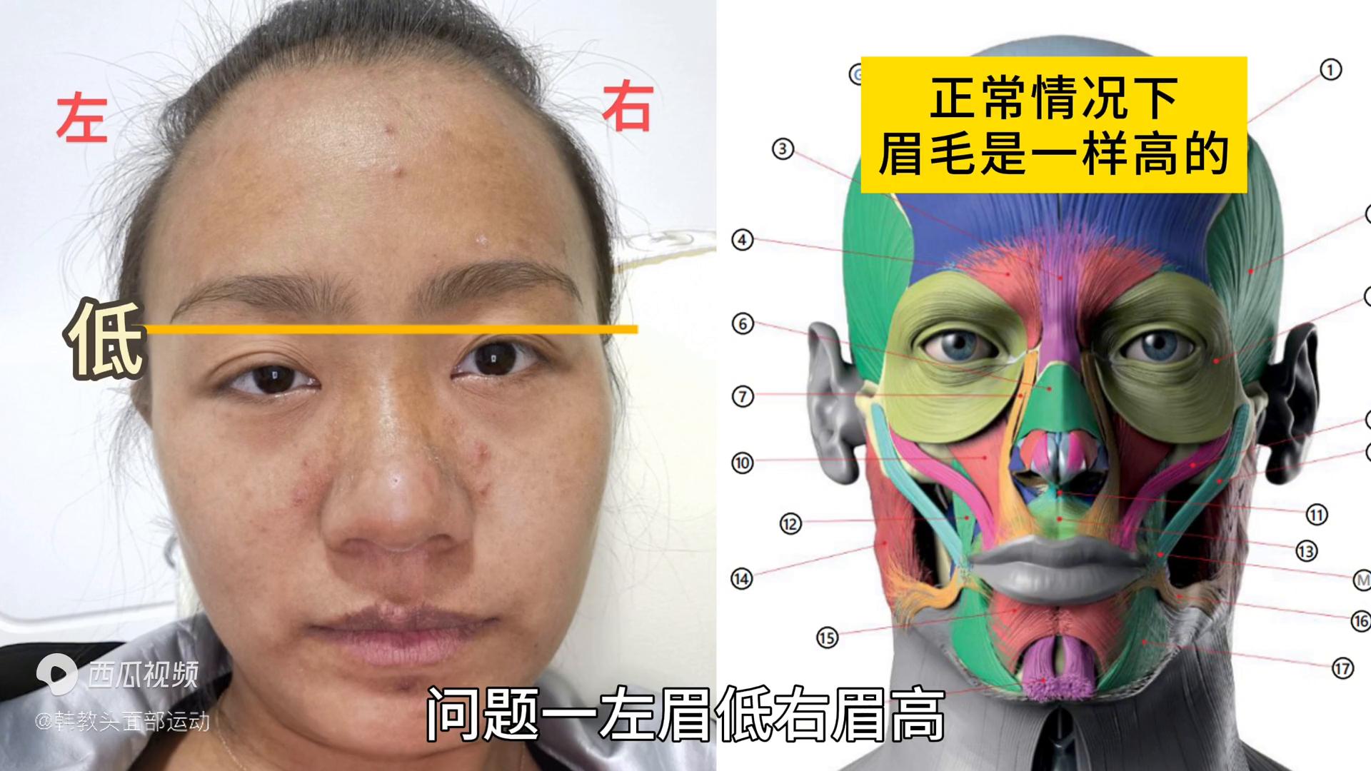 大小脸颧骨一边高一边低矫正,大小脸纠正颧骨突出